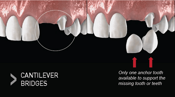 Cantilever Bridge Dental Procedure