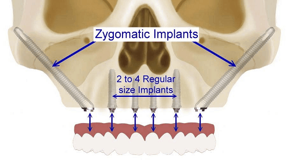 zygomatic-implants