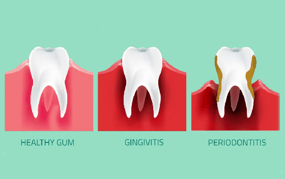 Gum disease problems