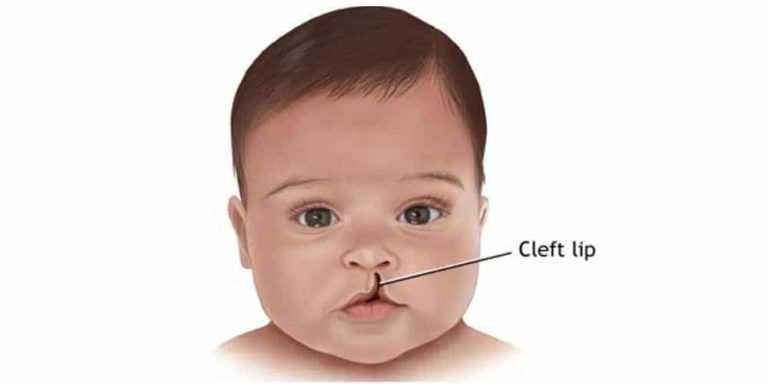 baby-cleft-lip-and-palate