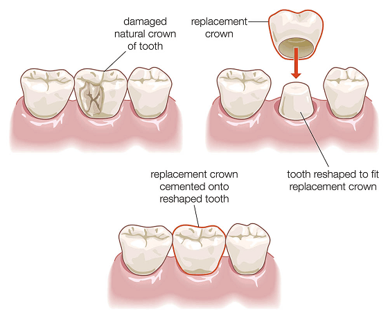 Cracked Tooth Syndrome