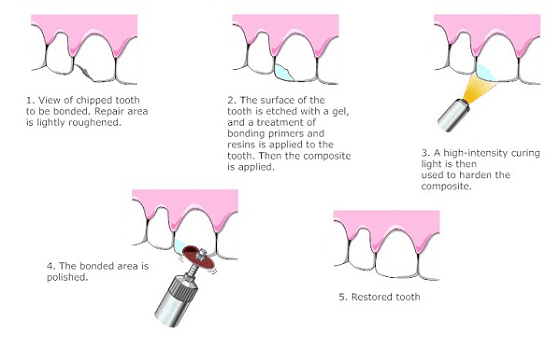 dental bonding