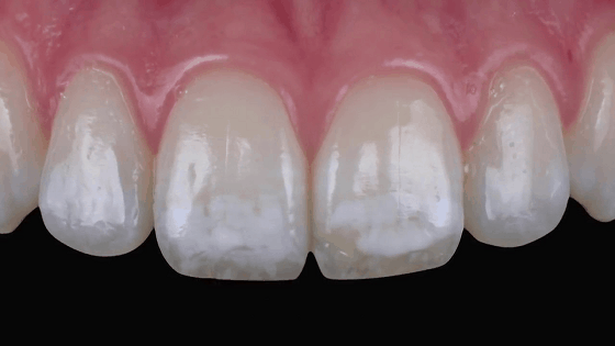 dental fluorosis