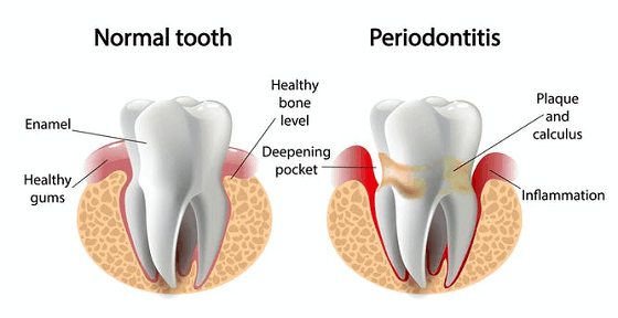 differences between gingivitis & periodontitis