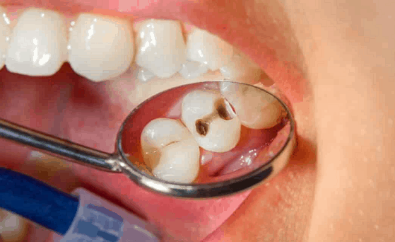 hole in teeth