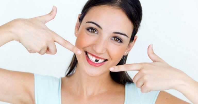 missing-teeth