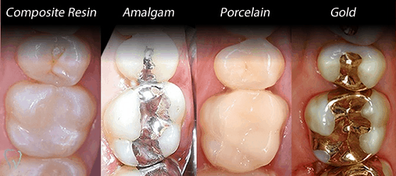 teeth filling