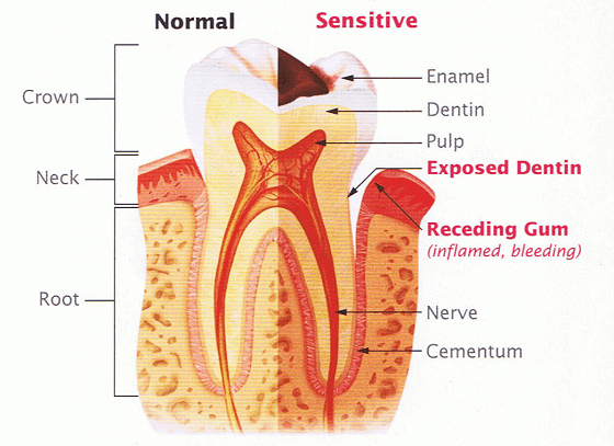 what causes sensitive teeth