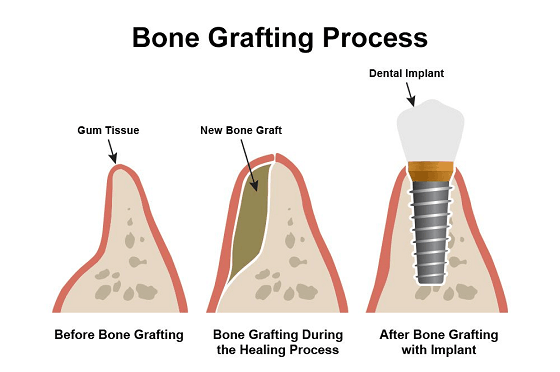 Bone Graft Process