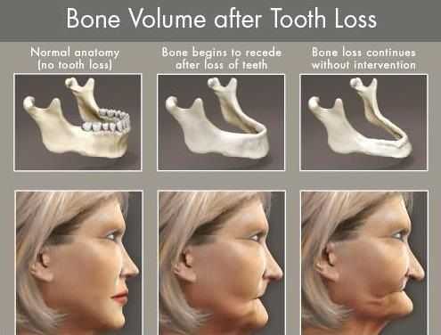 consequences of tooth loss
