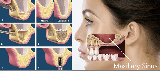 dental sinus lift