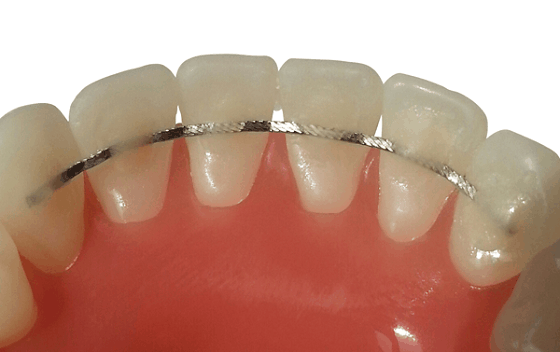 Which Type of Retainer Is Right for You? – Sabka Dentist – Top Dental ...