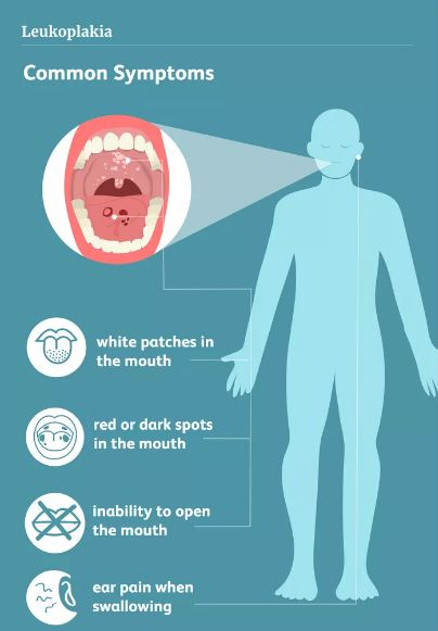 oral leukoplakia symptoms