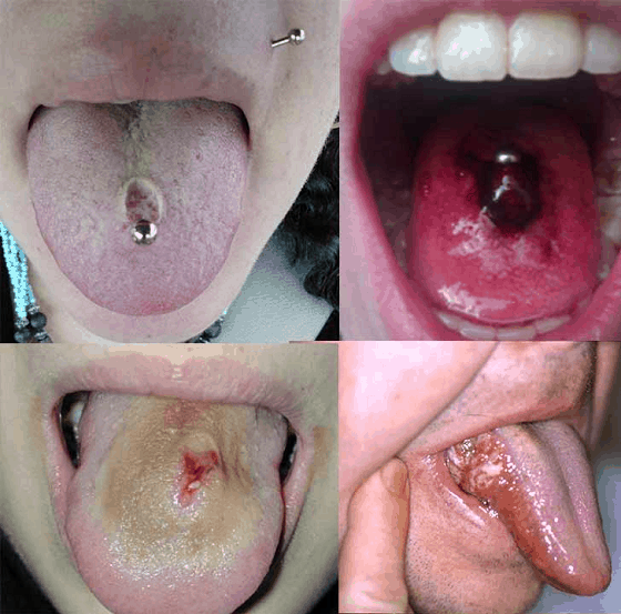 oral piercings risk