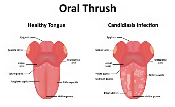 oral thrush infection