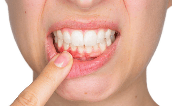 stress and oral health gum disease