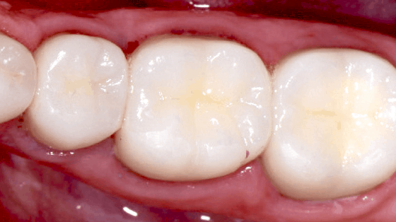 What is Amalgam Filling?