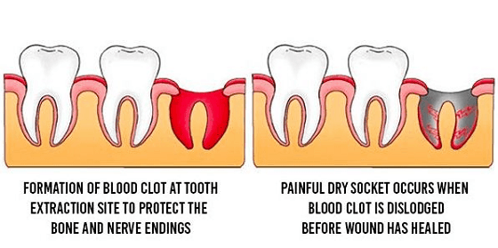 How to Identify and Deal with a Dry Socket?