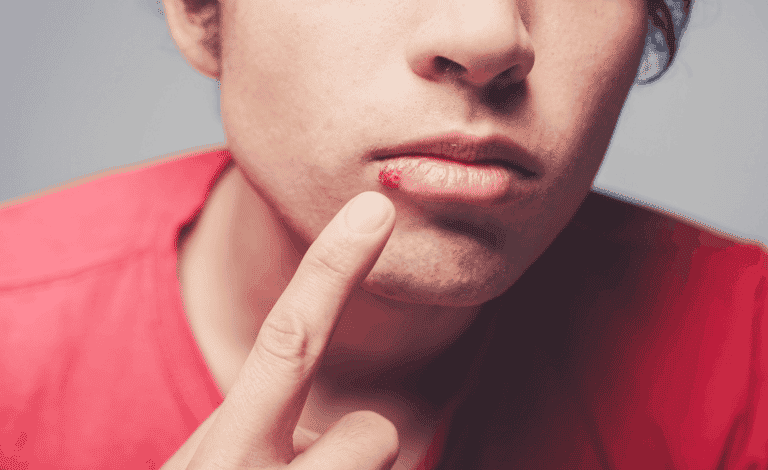 Oral-herpes-treatment