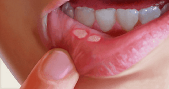 Oral-ulcer