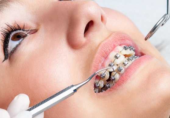 Procedure for Dental Braces