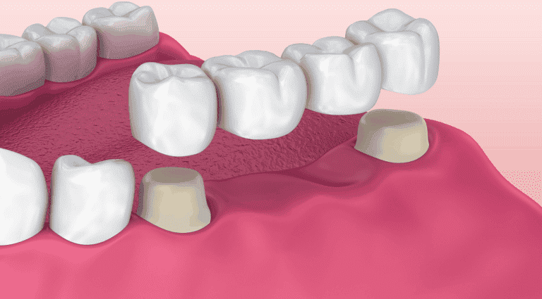 Types-of-dental-bridges