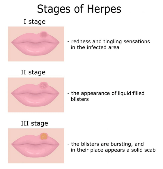 What-is-Herpes-Simplex