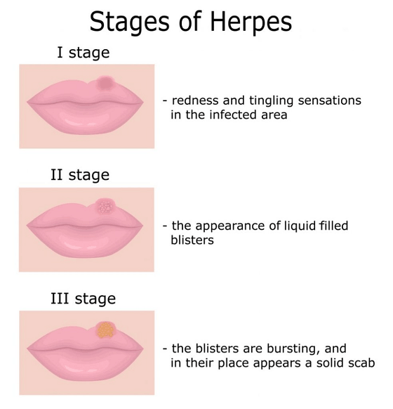 Herpes on deals lips causes