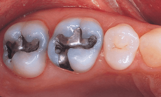 What is Amalgam Filling?