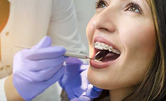 Procedure for Dental Braces