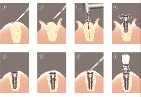 dental-implants-procedure-