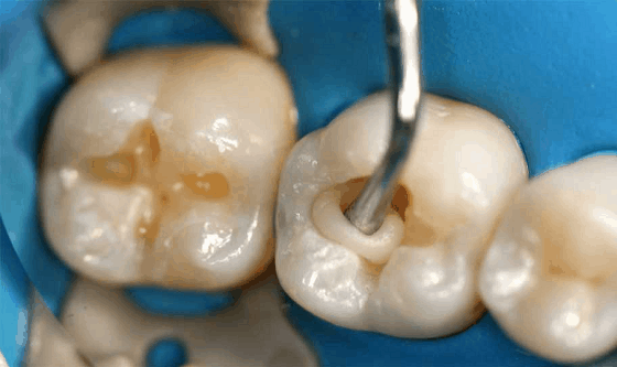 What is Amalgam Filling?