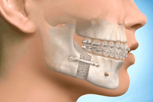 orthodontic & orthognathic surgery