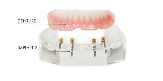 Anchored Denture Implant