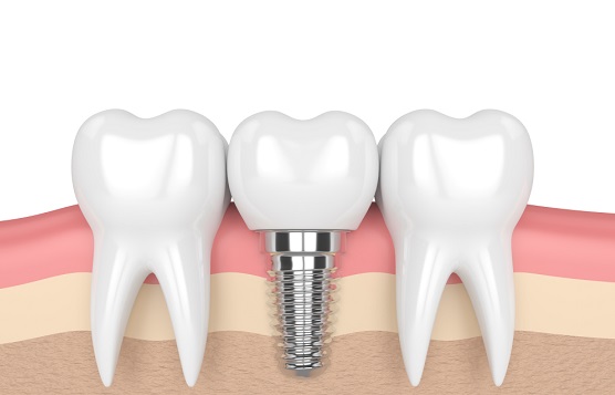 Bone structure of Dental Implant