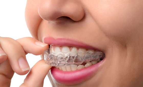 Elastics For Braces – Sabka Dentist – Top Dental Clinic Chain In India