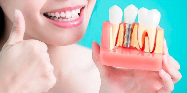 Dental-Implants-Jaw-Dropping-Facts