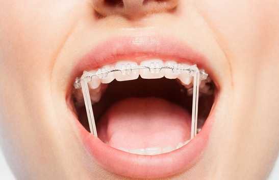Free Bands for Braces