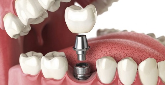 How Dental implant use