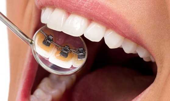 Elastics For Braces – Sabka Dentist – Top Dental Clinic Chain In India