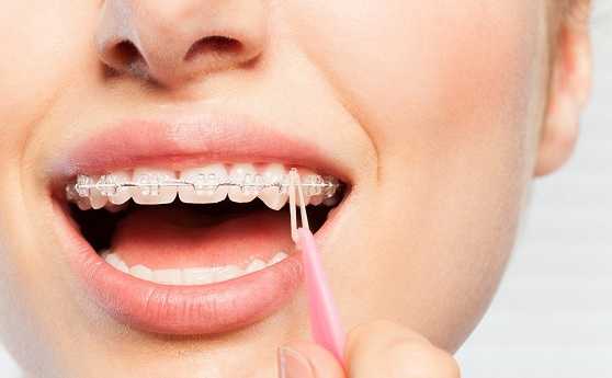 How elastics (rubber bands) SHOULD be used in orthodontics