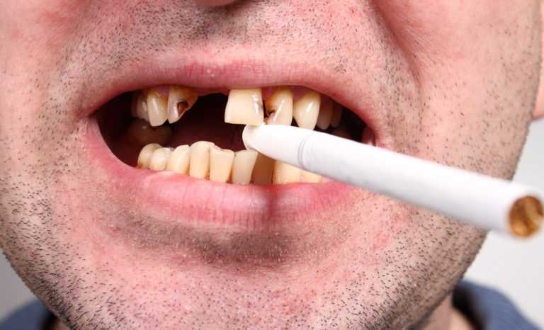 Smoking causes gum disease, oral cancer, and more