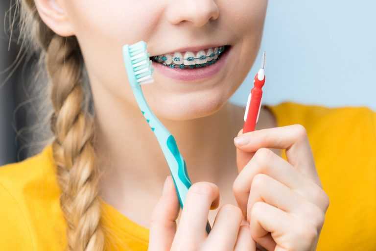 What-Happens-If-You-Have-Braces-and-Dont-Brush-Your-Teeth