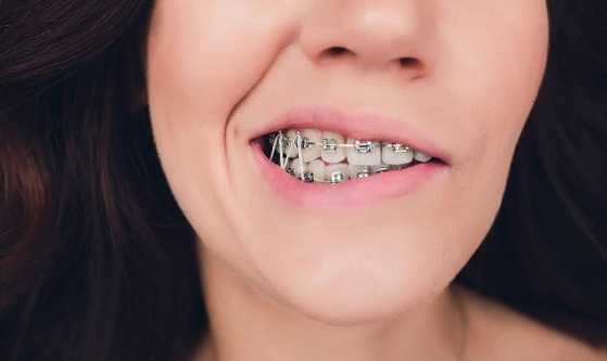 Elastics For Braces – Sabka Dentist – Top Dental Clinic Chain In India