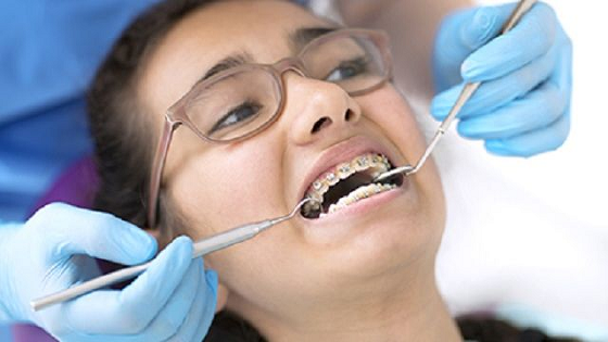 braces treatment in adults