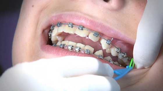 How elastics (rubber bands) SHOULD be used in orthodontics