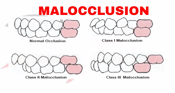 malocclusion class