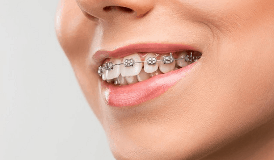 orthodontic treatment to correct bad bite