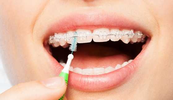 Cleaning of Braces