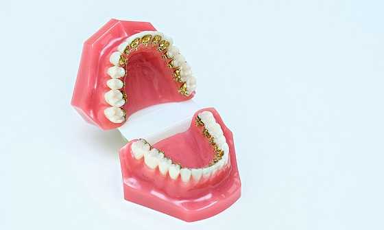 Lingual Braces Treatment